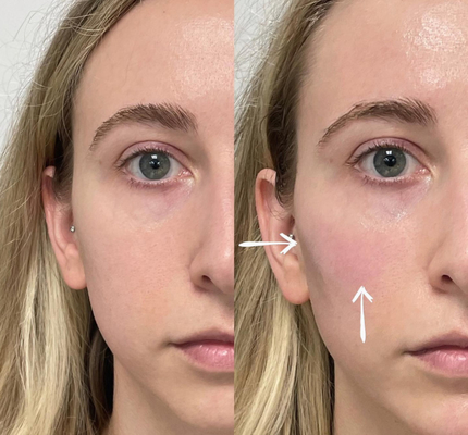 Skinjectの注射可能な深いHyaluronic酸の皮膚2ml唇の注入口