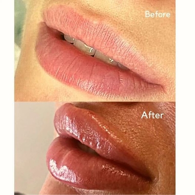 注射可能な注入口の注入Juvederms唇の容積のための超3 HAの皮膚注入口