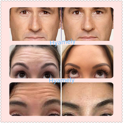 トルコのAllergan 長続きがするボツリヌス菌の毒素100つのIUの
