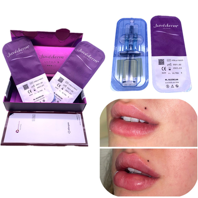 注入Haの注入口のJuvederm 2x1mlの唇の強化はしわを取除く