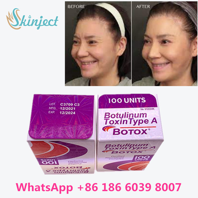 顔のしわのためのボツリヌス菌の毒素Allergan s 1x100iu