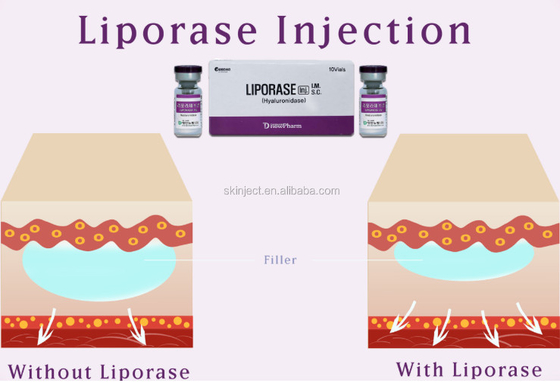 分解するべき皮膚注入口のための10 Vias Liporaseのヒアルウロニダーゼ