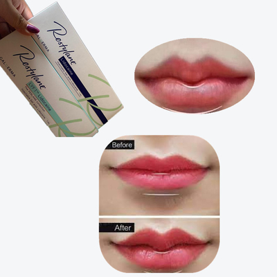 2*1ml/Box 交差リンクされた唇増殖用皮膚フィルラー