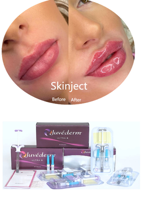 Juvederm ヒアルロン酸 顔用皮膚充填剤 注射用 2*1ml 梱包