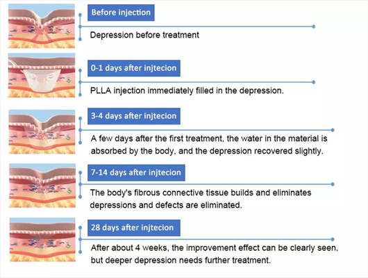 PLLA ポリ-L-乳酸 顔内注射 10 錠 150mg