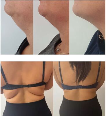 天然のレモンボトル 脂肪溶解溶液 リポリティス溶液