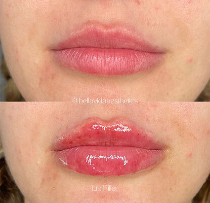 しわ軽減、顔の輪郭形成、肌の若返りのための注入用ジェル製剤、使用期限2年