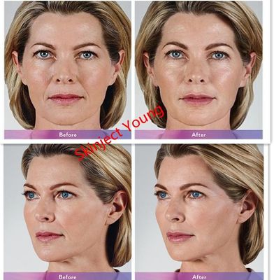 Juvederm Voluma 2x1mlのヒアルロン酸の注射可能なゲルの注入口