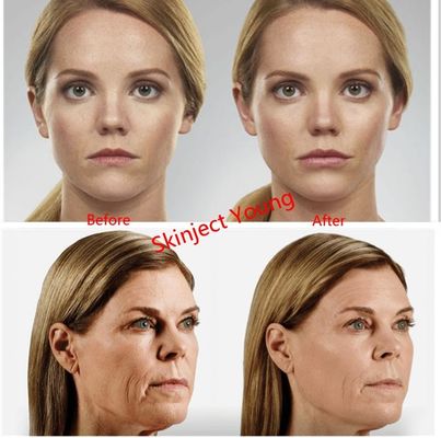 Juvederm Voluma 2x1mlのヒアルロン酸の注射可能なゲルの注入口
