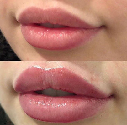 リドカインの十字によってつながれる皮膚注入口とのロシアの唇Juvederm超3