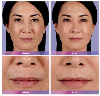 Juvedermの唇の拡大のための皮膚注入口の唇の注入超4