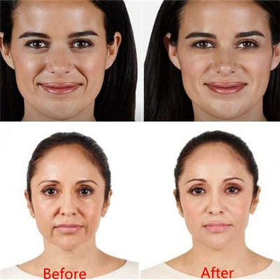 HA 2mlの皮膚注入口の唇の注入は注入口注射可能なJuvedermにしわを寄せる