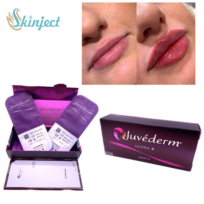 Nasolabial折目の唇2x1mlの皮膚注入口のHyaluronic酸Juvederm Ultra3