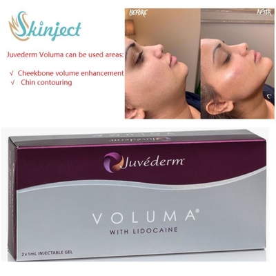 頬骨のためのJuvederm Voluma 2x1mlのHyaluronic酸の皮膚注入口