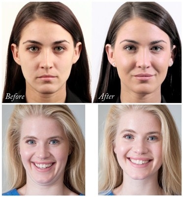 改善のJuvederm VolumaのHyaluronic酸の顔の注入口24のMg/Ml