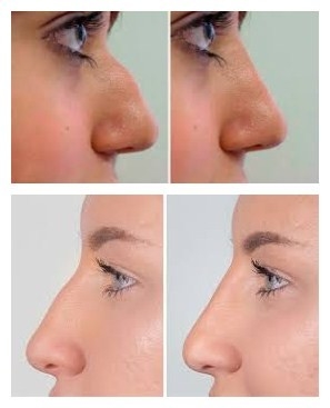 Chinおよび頬の増加のためのJuvederms VolumaのHyaluronic酸の顔の注入口