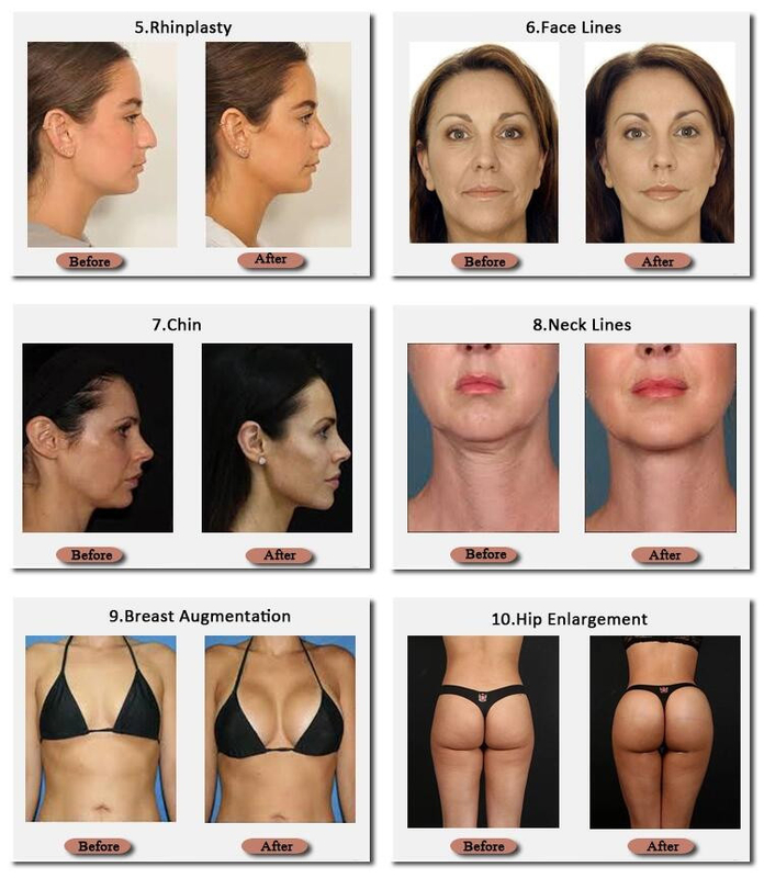 Skinjection 10のMlおよび20のMl Hyaluronic胸の注入口韓国のTechnnology 24のMg/Ml